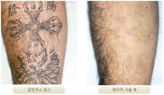 Duhan Plastic Surgery Laser Treatment - Mole Removal, Spot Removal, Melasma, Blemishes, Hyperpigmentation, Skin Tone Improvement, Elasticity Improvement, Skin Texture Improvement image 27