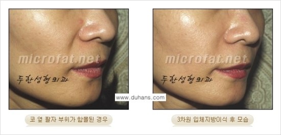 [두한성형외과 경쟁력 귀족성형] - [3차원 입체 미세지방이식 귀족수술 + 인디언밴드 교정] 관련 이미지 16