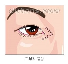 쌍커풀수술 두한성형외과 - 나에게 맞는 눈성형은? 관련 이미지 58