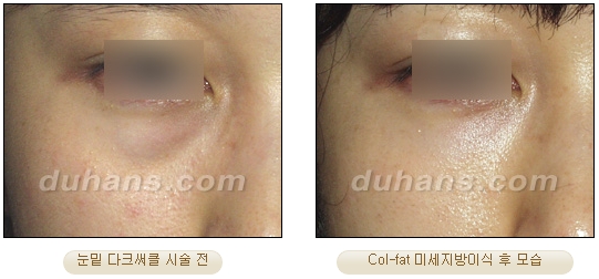[Duhan Plastic Surgery Facial Autologous Fat Grafting] - [Fat Grafting Guide] image 20