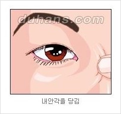 [두한성형외과 경쟁력 눈성형] - [흉터없는 몽고주름 제거술(앞트임) 관련 이미지 5