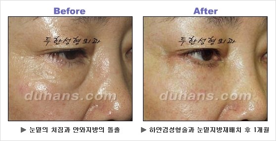 [두한성형외과 경쟁력 동안성형 리더] - ​[미간주름, 이마주름, 안검성형, 이마거상술, 눈썹거상술] 관련 이미지 74