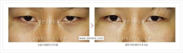 [두한성형외과 경쟁력 눈밑성형] - [눈밑이 전반적으로 함몰된 다크써클 교정 안내] 관련 이미지 16