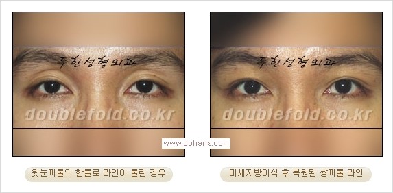 ​⁠⁠[두한성형외과 경쟁력 쌍꺼풀 재수술, 극한 눈재수술] - [지방이식으로 눈매와 쌍꺼풀 라인을 교정] 관련 이미지 15