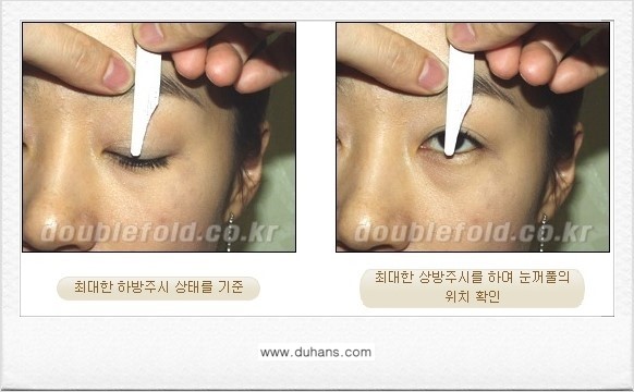 [두한성형외과 쌍꺼풀 재수술] - [쌍꺼풀 재수술 상담시 검사와 테스트] 관련 이미지 2
