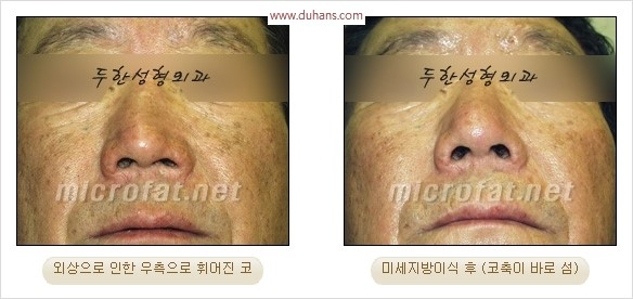 [두한성형외과 경쟁력 코성형 리더] - [자연스럽고 오똑한 콧망울! 코성형 방법]​ 관련 이미지 47