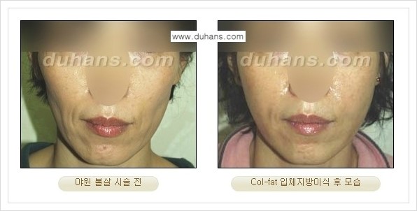 [두한성형외과 경쟁력 미세지방이식] - [지방이식 특허 Col-fat 미세지방이식 성공사례 안내] 관련 이미지 17