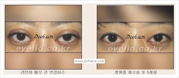 [두한성형외과 경쟁력 눈성형] - [안검하수와 몽고주름에 대한 자주하는 질문과 답변] 관련 이미지 7