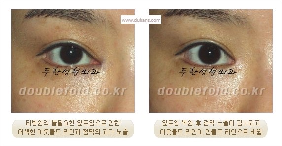 [두한성형외과 경쟁력 눈성형] - [쌍꺼풀 재수술 실패의 원인과 문제점] 관련 이미지 1