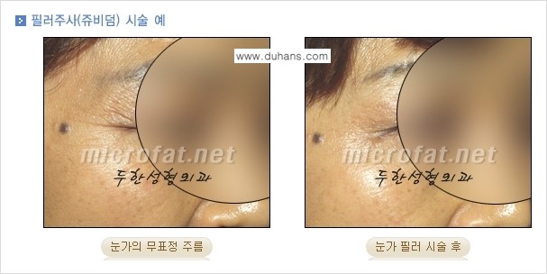 [두한성형외과 경쟁력 퀵성형] - [필러주사(쥬비덤)으로  간단하고 빠르게 주름교정] 관련 이미지 15