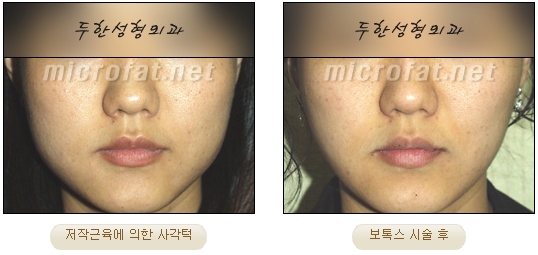 [두한성형외과 보톡스] - [사각턱 보톡스 시술 안내] 관련 이미지 18