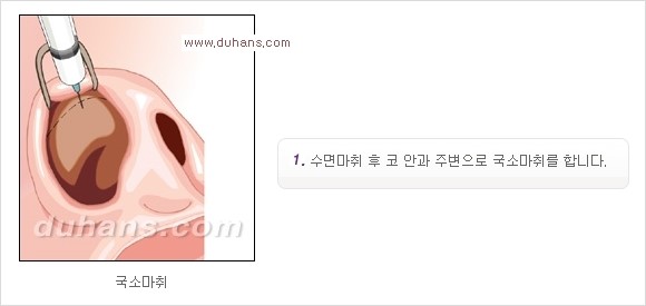[두한성형외과 경쟁력 코성형] - [코성형을 위한 알로덤(슈어덤) 수술, 실리콘 수술 안내] 관련 이미지 19