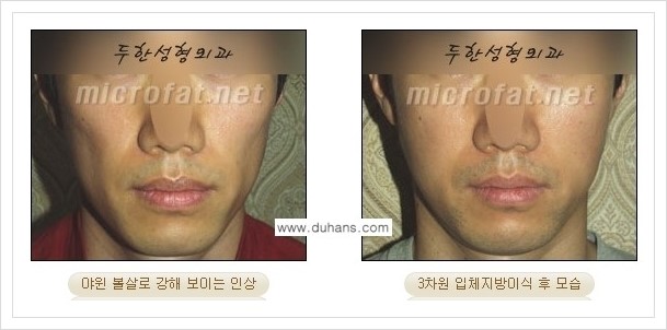 [두한성형외과 경쟁력 윤곽성형] - [볼, 볼살 지방이식] 관련 이미지 31