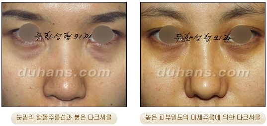 두한성형외과 눈밑성형 - 눈밑지방제거, 눈밑주름, 눈밑지방재배치 관련 이미지 54