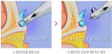[눈밑수술 두한성형외과] - [다크서클 콤비프로그램] 관련 이미지 149