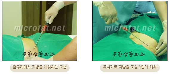 [두한성형외과 미세지방이식] - [무턱교정 안내] 관련 이미지 9