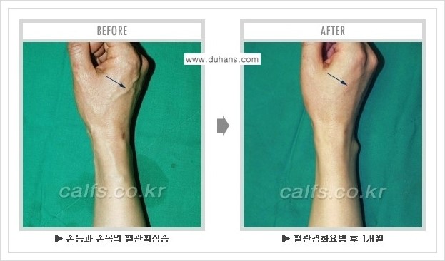[두한성형외과 정맥류 치료] - [손, 팔 정맥확장증 사진자료 안내 ①] 관련 이미지 12