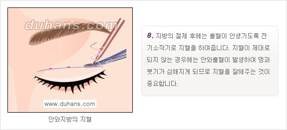 [두한성형외과 경쟁력 눈성형]- [최소 부기로 일상의로의 복귀가 가능한 아름다운 퀵쌍꺼풀(부분절개법) 수술] 관련 이미지 8