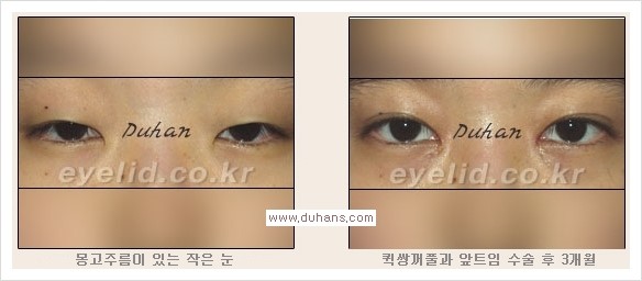 [두한성형외과 경쟁력 눈성형] - [퀵쌍꺼풀(부분절개법) 안내] 관련 이미지 3