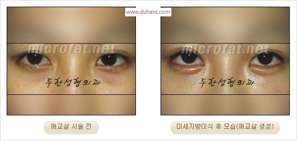​﻿[두한성형외과 경쟁력 지방이식] - [눈밑 애교살 시술을 위한 미세지방이식] 관련 이미지 36