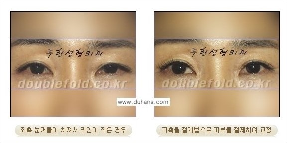 [두한성형외과 경쟁력 쌍꺼풀 재수술] - [짝짝이 쌍꺼풀 라인 교정] 관련 이미지 2