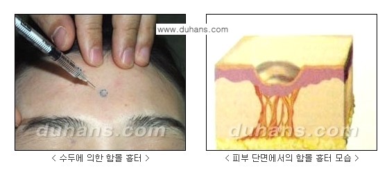 [두한성형외과 흉터 교정] - [함몰흉터의 DHC 시술] 관련 이미지 1