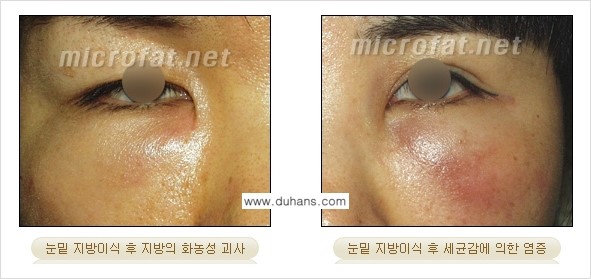 [두한성형외과 경쟁력 "미세지방이식"] - [미세지방이식의 잘못된 지식 1.] 관련 이미지 13