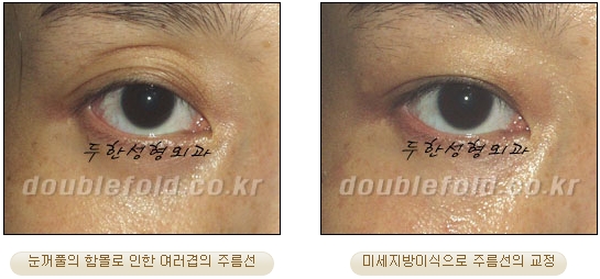 [두한성형외과 눈재수술] - [재수술 방법들] 관련 이미지 29