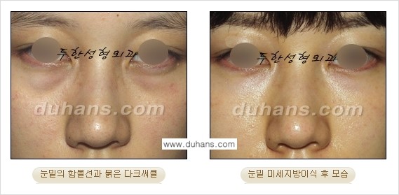 [두한성형외과 FOCUS 눈밑성형] - [다크써클의 치료방법 -  콜펫(Col-fat) 눈밑 미세지방이식 ⑤] 관련 이미지 8