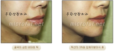 [Duhan Plastic Surgery Clinic Microgenia Correction] - [Chin Microfat Grafting] image 22