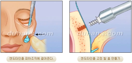 두한성형외과 안티에이징 리프팅 - 엔도타인 리프팅 관련 이미지 40