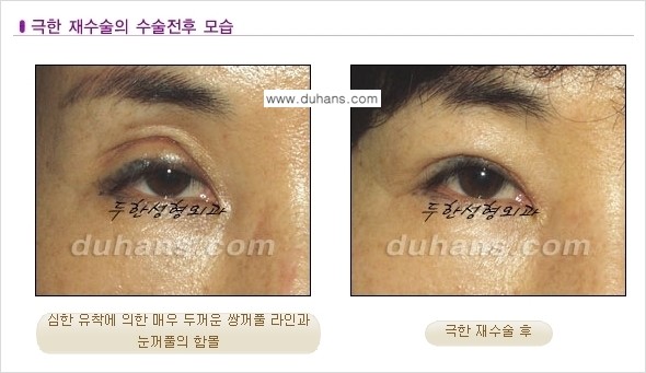 [두한성형외과 경쟁력 눈성형] - [두꺼운 라인을 교정하는 극한 눈 재수술 1.] 관련 이미지 4