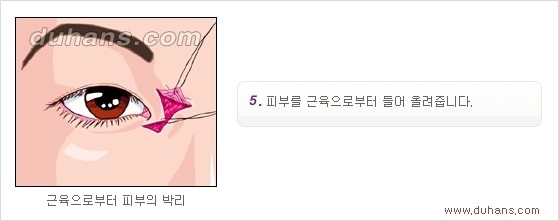 [두한성형외과 경쟁력 눈성형] - [흉터없는 몽고주름 제거 - 앞트임 수술 안내] 관련 이미지 13