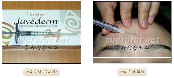 [Duhan Plastic Surgery Wrinkle Improvement] - [Wrinkle Filler Procedure] image 1