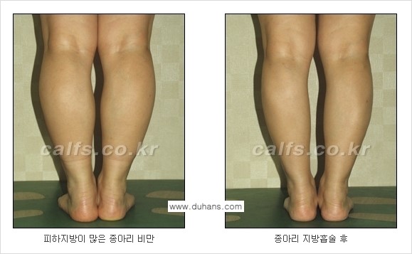 [두한성형외과 경쟁력 종아리성형] - [종아리 지방흡입 2.] 관련 이미지 4