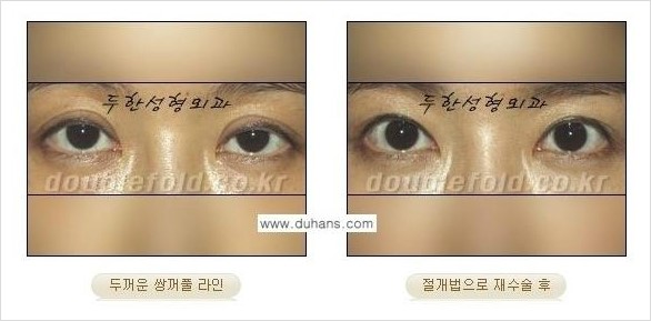 [두한성형외과 경쟁력 눈성형] - [두껍고 수술한 표시가 나는 어색한 쌍꺼풀 라인의 교정 방법] 관련 이미지 14