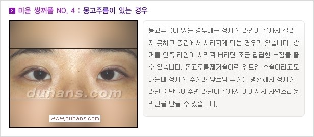 [두한성형외과 경쟁력 쌍꺼풀 재수술, 극한 눈재수술] - [자연스러운 눈매로의 복원 쌍꺼풀 재수술 대상 안내] 관련 이미지 5