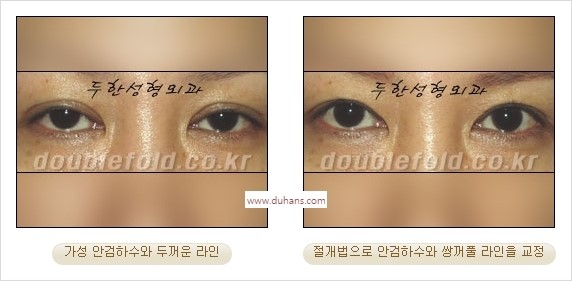 ⁠⁠[두한성형외과 경﻿쟁력 쌍꺼풀 재수술] - [안검하수(졸리운 눈매) 종류와 교정 방법 안내] 관련 이미지 23