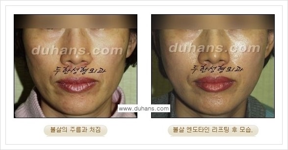 [두한성형외과 경쟁력 주름성형] - [엔도타인 리프팅 안내 ②] 관련 이미지 3