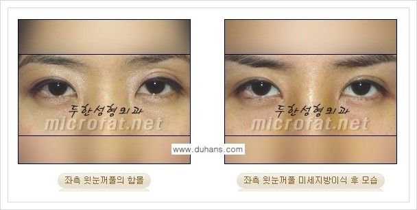 [두한성형외과의 경쟁력 미세지방이식] - [꺼진 눈꺼풀(윗눈꺼풀 함몰) 미세지방이식 안내] 관련 이미지 5