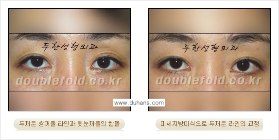 [두한성형외과 NO.1 눈성형] - [함몰된(꺼진) 눈꺼풀에서 쌍꺼풀 라인 교정 2.] 관련 이미지 15