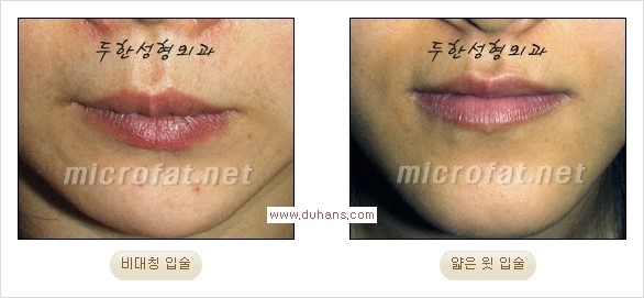 [두한성형외과 경쟁력 미세지방이식] - [입술 3차원 입체지방이식 안내 1.] 관련 이미지 1