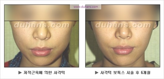 [두한성형외과 경쟁력 안면윤곽 성형 리더] - [완변한 V 라인! 턱 미세지방이식, 볼살 미세지방이식, 사각턱 보톡스 안내] 관련 이미지 30