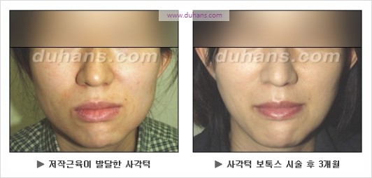 [두한성형외과 경쟁력 안면윤곽 성형 리더] - [완변한 V 라인! 턱 미세지방이식, 볼살 미세지방이식, 사각턱 보톡스 안내] 관련 이미지 41