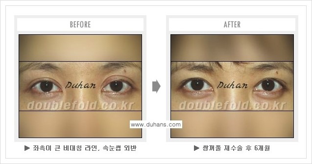 [두한성형외과 경쟁력 쌍꺼풀 재수술, 극한 눈재수술] - [쌍꺼풀 재수술, 극한 눈재수술 관련 자주하는 질문과 답변] 관련 이미지 14