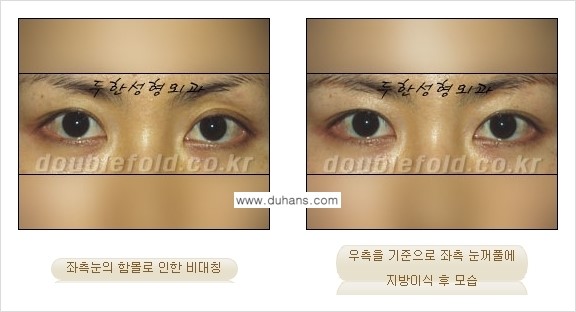 [두한성형외과 경쟁력 눈성형] - [미세지방이식으로 비대칭 쌍꺼풀 라인의 교정 방법 안내] 관련 이미지 3