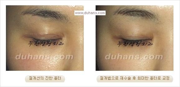 [두한성형외과 경쟁력 쌍꺼풀 재수술, 극한 눈재수술] - [절개법 수술후 쌍꺼풀 흉터선이 진한 경우의 교정 안내] 관련 이미지 5