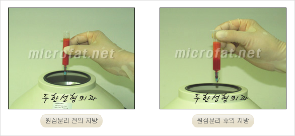 [두한성형외과 경쟁력 안면윤곽 성형 리더] - [완변한 V 라인! 턱 미세지방이식, 볼살 미세지방이식, 사각턱 보톡스 안내] 관련 이미지 9