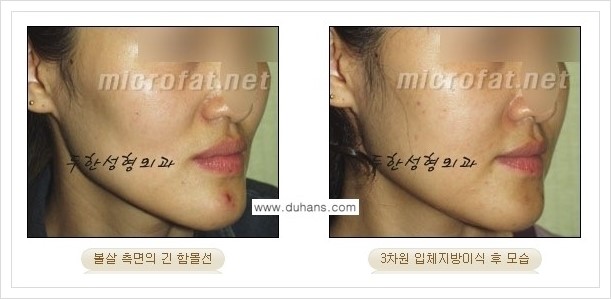 [두한성형외과 경쟁력 볼살지방이식] - [사각턱의 경우, 측면 볼살의 함몰선, 안면비대칭, 남성 야윈볼살 안내] 관련 이미지 7