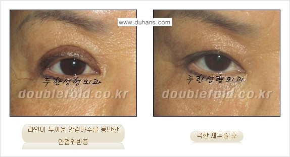 [두한성형외과 NO.1 "극한 눈 재수술"] - [극한 눈 재수술 성공사례 ①] 관련 이미지 9